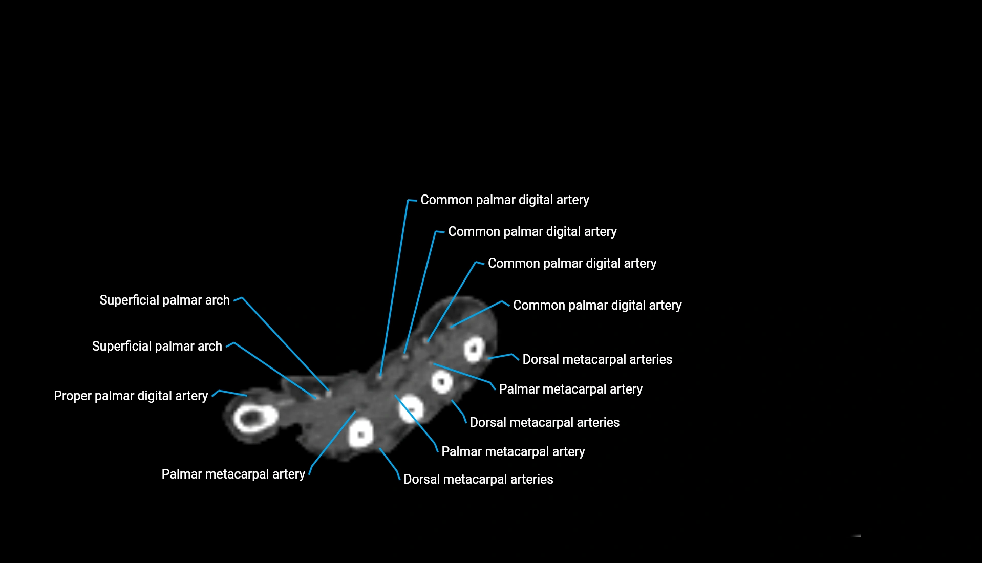 CTA upper limb axial cross sectional anatomy labelled image 56 (2).webp